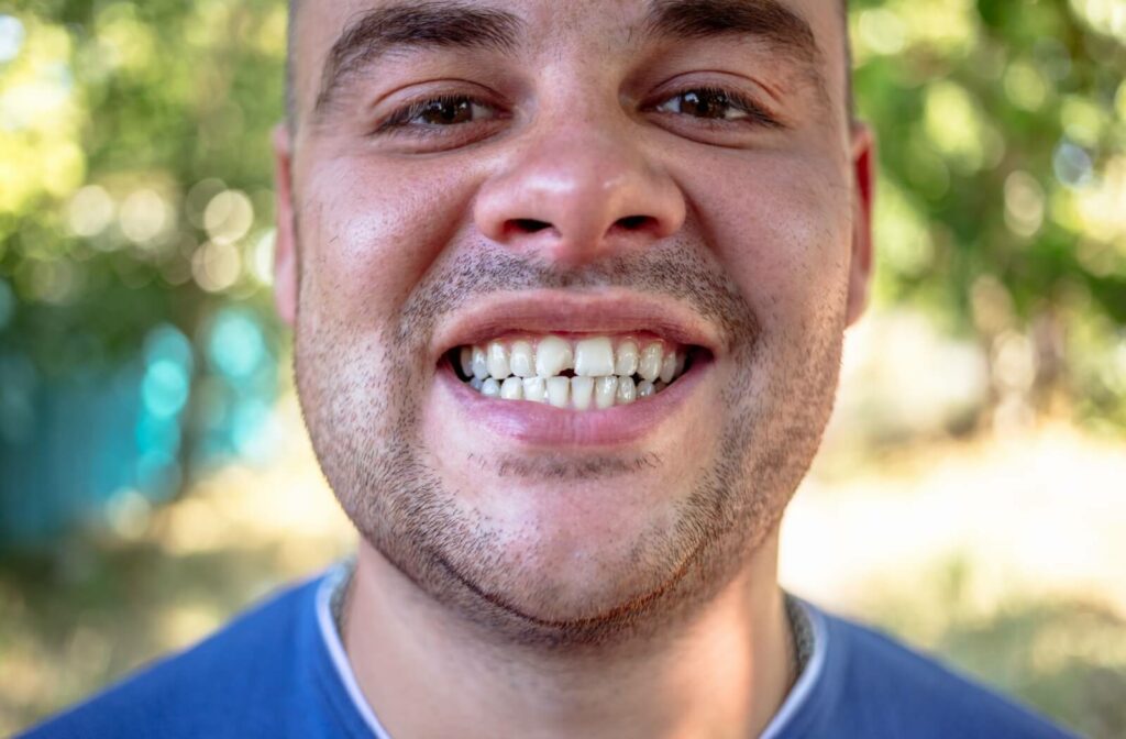 A man in a blue t-shirt smiling and showing a chipped front tooth.