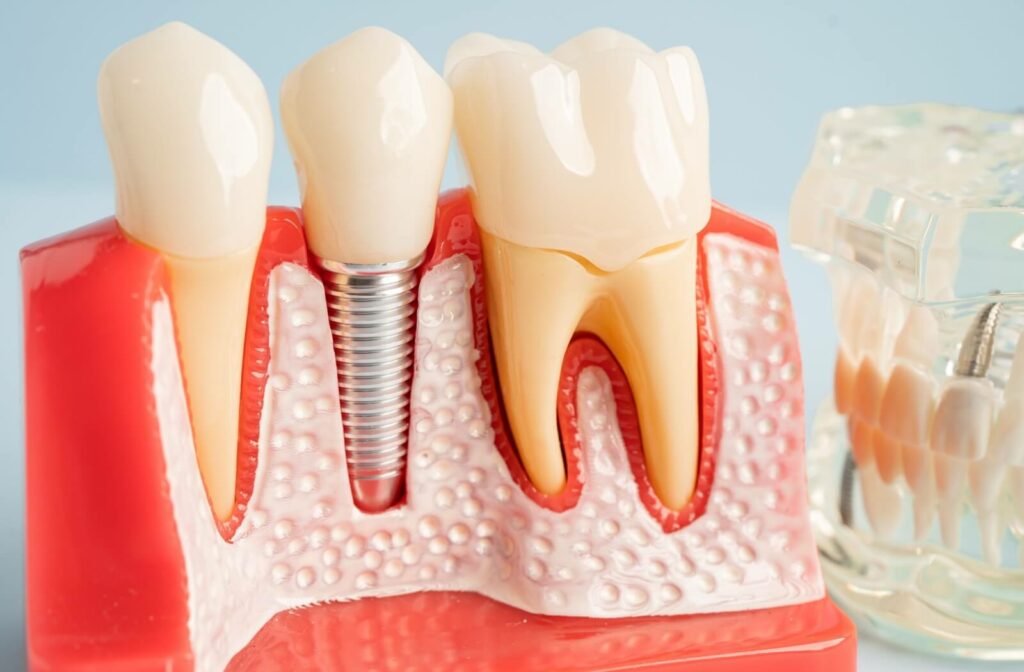 A dental model of the teeth and gums showing a dental implant.