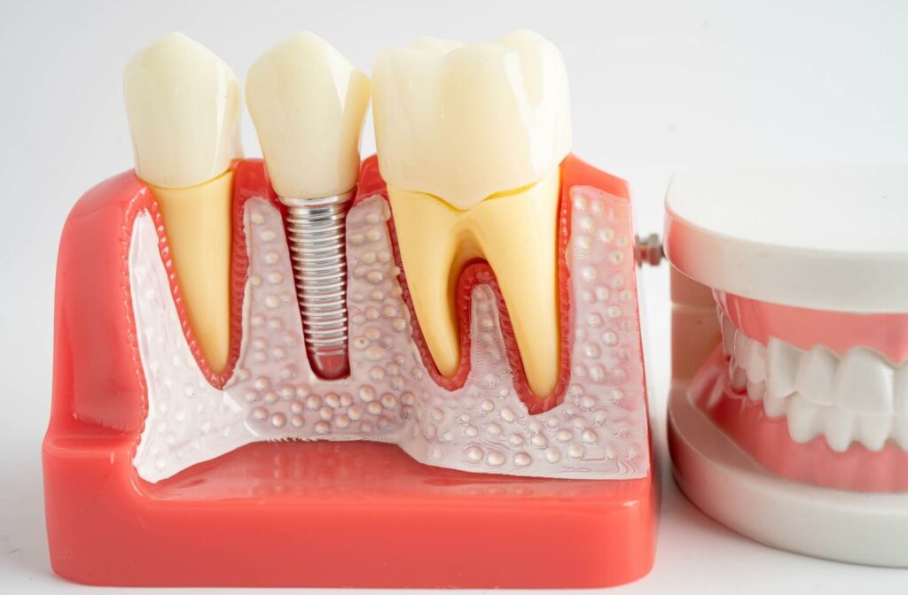 An image of a 3D model that shows how a dental implant works.