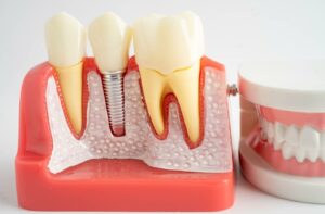An image of a 3D model that shows how a dental implant works.