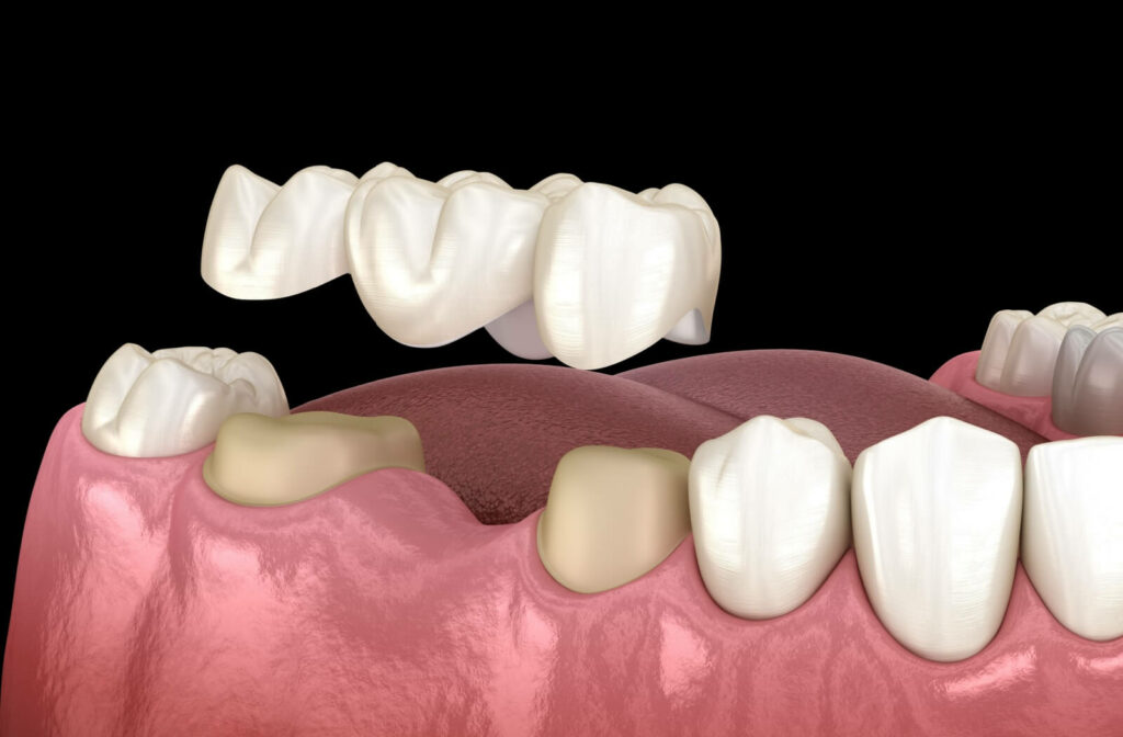 3D illustration of a dental bridge being placed over prepared teeth to replace a missing tooth in the lower jaw.