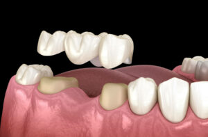 3D illustration of a dental bridge being placed over prepared teeth to replace a missing tooth in the lower jaw.