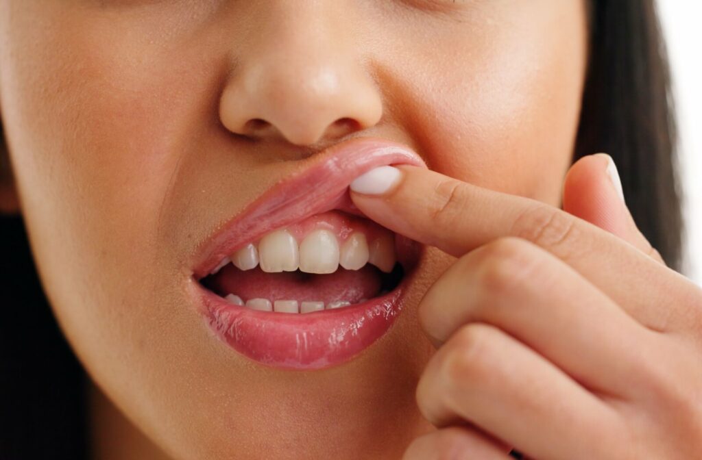 A close-up of a person pulling back their lip to examine red, inflamed gums, illustrating common signs of transmittable gum disease or gingivitis.